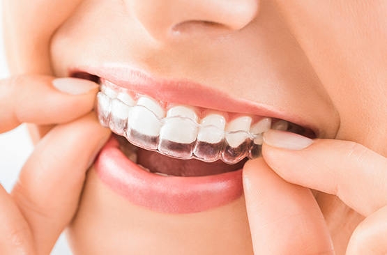 Brackets Autoligado