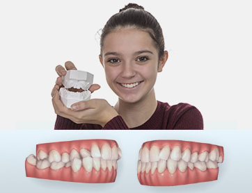 Modelos de escayola de los dientes